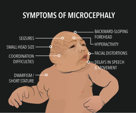 microcephaly